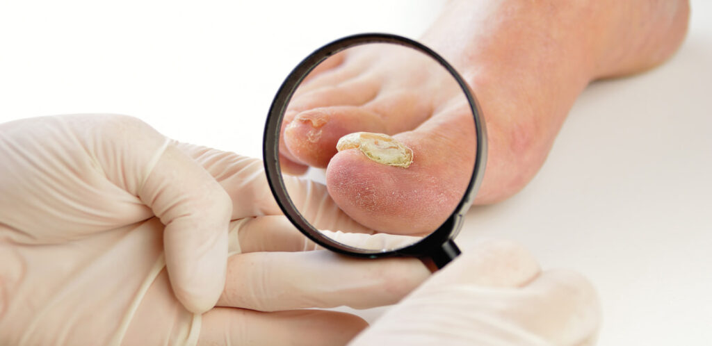 Laser for Fungal Nail Infection