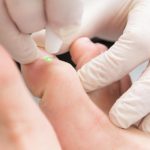 laserfungalnailclinic34-150x150